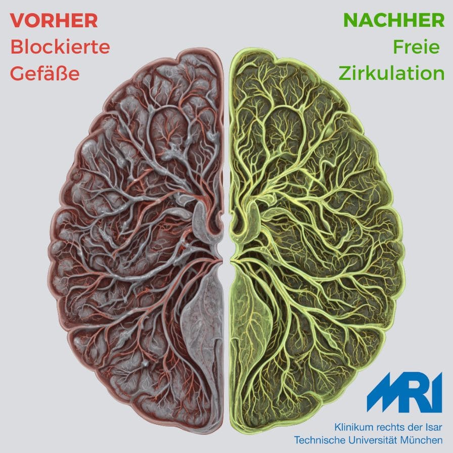 Blockierte Gefäße – Darstellung vor der Auflösung von Fibrin-Blockaden