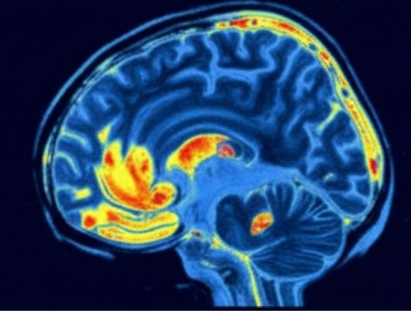 Gehirn-Scan vor der Anwendung: verminderte Aktivität