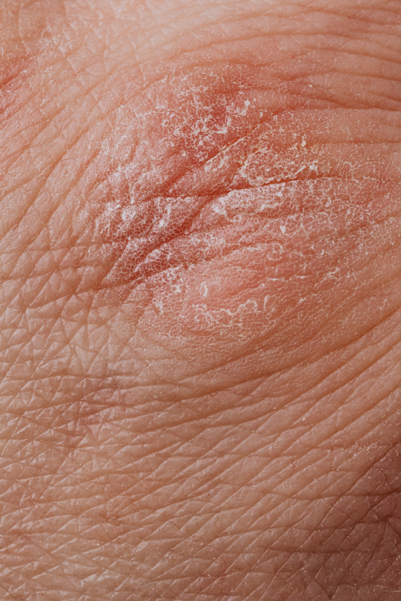 Trockene Haut: Ursachen und Tipps